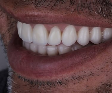 Sorriso confiante após tratamento com implantes