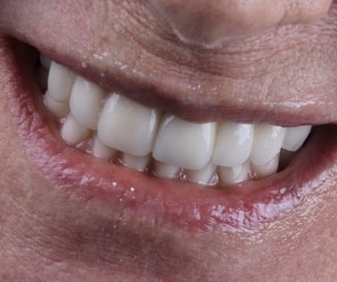 Sorriso natural após tratamento com implantes
