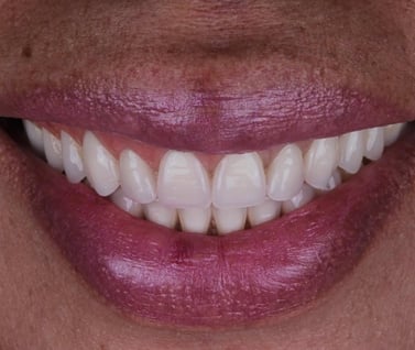 Sorriso duradouro após tratamento com implantes